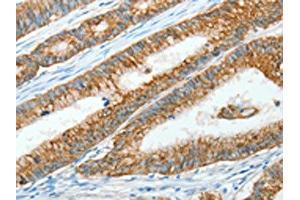 The image on the left is immunohistochemistry of paraffin-embedded Human colon cancer tissue using ABIN7128299(AGR3 Antibody) at dilution 1/15, on the right is treated with fusion protein.