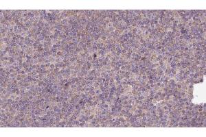 ABIN6273142 at 1/100 staining Human lymph cancer tissue by IHC-P. (Myosin XVIIIA 抗体  (Internal Region))