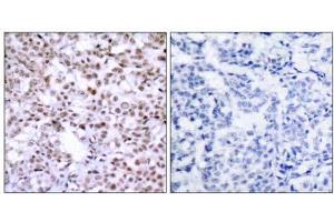 Immunohistochemical analysis of paraffin-embedded human breast carcinoma tissue using Chk2 (Ab-68) antibody (E021087). (CHEK2 抗体)