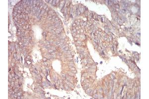 Immunohistochemical analysis of paraffin-embedded rectum cancer tissues using 1-193 mouse mAb with DAB staining. (alpha Adducin 抗体  (AA 1-193))