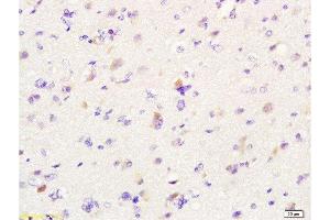 Formalin-fixed and paraffin embedded human glioma labeled with Anti-MIF Polyclonal Antibody, Unconjugated  at 1:200 followed by conjugation to the secondary antibody and DAB staining. (MIF 抗体  (AA 51-115))