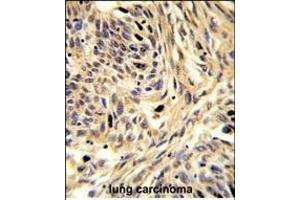 Formalin-fixed and paraffin-embedded human lung carcinoma reacted with HSPD1 Antibody (C-term), which was peroxidase-conjugated to the secondary antibody, followed by DAB staining. (HSPD1 抗体  (C-Term))