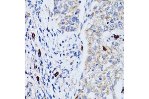 Immunohistochemistry of paraffin-embedded human lung cancer using MAP1LC3B antibody. (LC3B 抗体)