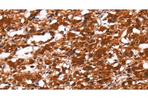 Immunohistochemistry of paraffin-embedded Human thyroid cancer using FUT1 Polyclonal Antibody at dilution of 1:30 (FUT1 抗体)