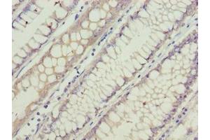 Immunohistochemistry of paraffin-embedded human colon cancer using ABIN7153839 at dilution of 1:100 (GCSAML 抗体  (AA 1-135))