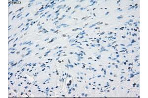Immunohistochemical staining of paraffin-embedded Adenocarcinoma of colon tissue using anti-AURKCmouse monoclonal antibody. (Aurora Kinase C 抗体)