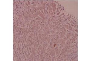 Immunohistochemistry analysis of ADM Antibody in paraffin-embedded human breast carcinoma tissue at 1/100. (Adrenomedullin 抗体)