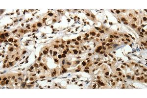 Immunohistochemistry of paraffin-embedded Human lung cancer tissue using SCN1A Polyclonal Antibody at dilution 1:40 (SCN1A 抗体)