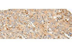 Immunohistochemistry of paraffin-embedded Human cervical cancer tissue using SLC5A1 Polyclonal Antibody at dilution of 1:80(x200) (SLC5A1 抗体)