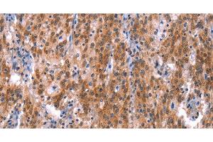 Immunohistochemistry of paraffin-embedded Human gastric cancer using GH1 Polyclonal Antibody at dilution of 1:40 (Growth Hormone 1 抗体)