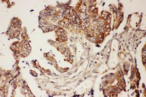 Anti-CNTF Picoband antibody,  IHC(P): Human Intestinal Cancer Tissue (CNTF 抗体  (AA 2-200))