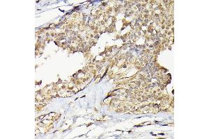 Immunohistochemistry of paraffin-embedded human breast cancer using T Rabbit pAb (ABIN6129486, ABIN6148851, ABIN6148852 and ABIN6223435) at dilution of 1:200 (40x lens). (TARBP2 抗体  (AA 1-366))