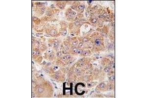 Formalin-fixed and paraffin-embedded human hepatocarcinoma tissue reacted with hUVRAG (N-term ), which was peroxidase-conjugated to the secondary antibody, followed by DAB staining. (UVRAG 抗体  (AA 120-152))