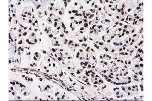 Immunohistochemical staining of paraffin-embedded Adenocarcinoma of Human colon tissue using anti-ATP6V1F mouse monoclonal antibody. (ATP6V1F 抗体)