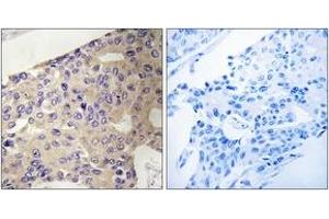 Immunohistochemistry analysis of paraffin-embedded human breast carcinoma tissue, using PEX10 Antibody. (PEX10 抗体  (AA 183-232))