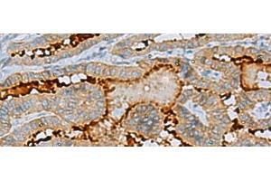 Immunohistochemistry of paraffin-embedded Human thyroid cancer tissue using ENKD1 Polyclonal Antibody at dilution of 1:75(x200) (ENKD1 抗体)