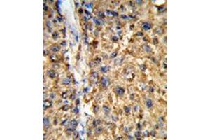 Immunohistochemistry in Formalin-fixed and paraffin-embedded human hepatocarcinoma reacted with GSTA2 / GST2 Antibody (N-term) followed which was peroxidase-conjugated to the secondary antibody, followed by DAB staining.