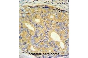 ZNF9 Antibody (Center) (ABIN650981 and ABIN2840021) IHC analysis in formalin fixed and paraffin embedded prostate carcinoma followed by peroxidase conjugation of the secondary antibody and DAB staining. (CNBP 抗体  (AA 67-96))