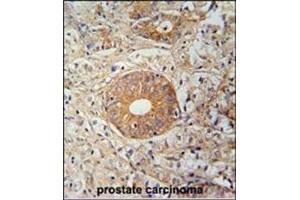 Immunohistochemistry analysis in Formalin Fixed, Paraffin Embedded Human prostate carcinoma stained with SLC35E2 Antibody (N-term) followed by peroxidase conjugation of the secondary antibody and DAB staining. (SLC35E2 抗体  (N-Term))