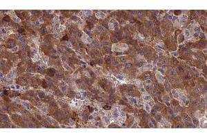 ABIN6277338 at 1/100 staining Human liver cancer tissue by IHC-P. (CDH23 抗体  (N-Term))