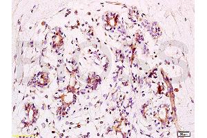 Formalin-fixed and human breast carcinoma tissue labeled with Anti-phospho-BACH1/BRIP1(Ser990) Polyclonal Antibody, Unconjugated  at 1:200 followed by conjugation to the secondary antibody and DAB staining (BRIP1 抗体  (pSer990))
