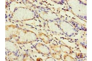 Immunohistochemistry of paraffin-embedded human gastric cancer using ABIN7172261 at dilution of 1:100 (TLR1 抗体  (AA 25-580))