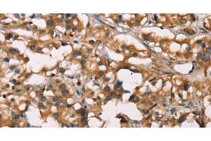Immunohistochemistry of paraffin-embedded Human thyroid cancer using SENP1 Polyclonal Antibody at dilution of 1:40 (SENP1 抗体)