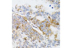 Immunohistochemistry of paraffin-embedded human gastric cancer using PDYN antibody. (PDYN 抗体)
