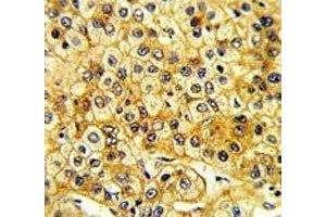 IHC analysis of FFPE human hepatocarcinoma with Src antibody (Src 抗体  (AA 397-424))