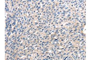 The image on the left is immunohistochemistry of paraffin-embedded Human breast cancer tissue using ABIN7127958(CENPM Antibody) at dilution 1/30, on the right is treated with fusion protein. (CENPM 抗体)