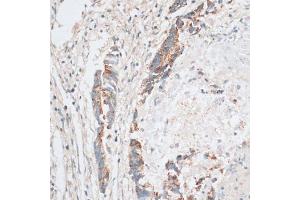 Immunohistochemistry of paraffin-embedded human colon carcinoma using HMGCR antibody (ABIN6293218) at dilution of 1:100 (40x lens). (HMGCR 抗体)