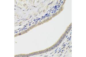 Immunohistochemistry of paraffin-embedded human adenomyosis using HDAC4 Antibody (ABIN5975864) at dilution of 1/100 (40x lens). (HDAC4 抗体)