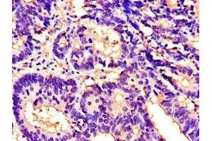 Immunohistochemistry of paraffin-embedded human colon cancer using ABIN7156464 at dilution of 1:100 (CD11b 抗体  (AA 46-150))