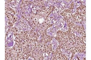 Paraformaldehyde-fixed, paraffin embedded Human stomach cancer Antigen retrieval by boiling in sodium citrate buffer (pH6. (Cytokeratin 18 抗体  (pSer60))