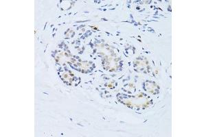 Immunohistochemistry of paraffin-embedded human breast using CDKN1A antibody (ABIN4903234) at dilution of 1:100 (40x lens). (p21 抗体)