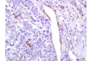 Formalin-fixed and paraffin embedded human lung carcinoma labeled with Anti-Phospho-PLK1 (Ser137) Polyclonal Antibody, Unconjugated (ABIN744938) at 1:200 followed by conjugation to the secondary antibody and DAB staining (PLK1 抗体  (pSer137))
