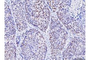 IHC analysis of MSH2 using anti-MSH2 antibody (ABIN7601369). (MSH2 抗体  (AA 337-583))