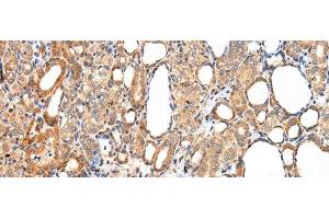 Immunohistochemistry of paraffin-embedded Human thyroid cancer tissue using AQP7 Polyclonal Antibody at dilution 1:40 (Aquaporin 7 抗体)