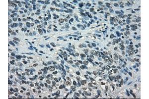 Immunohistochemical staining of paraffin-embedded Carcinoma of thyroid tissue using anti-STAT1mouse monoclonal antibody. (STAT1 抗体)