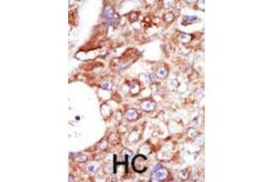 Formalin-fixed and paraffin-embedded human cancer tissue reacted with the primary antibody, which was peroxidase-conjugated to the secondary antibody, followed by AEC staining. (SYK 抗体  (C-Term))