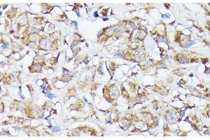 Immunohistochemistry of paraffin-embedded Human mammary cancer using MTHFD2 Polyclonal Antibody at dilution of 1:100 (40x lens). (MTHFD2 抗体)