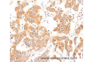Immunohistochemistry of Human breast cancer using PRDX2 Polyclonal Antibody at dilution of 1:80 (Peroxiredoxin 2 抗体)