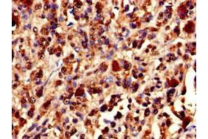 Immunohistochemistry of paraffin-embedded human melanoma using ABIN7175897 at dilution of 1:100