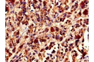 Immunohistochemistry of paraffin-embedded human melanoma using ABIN7175897 at dilution of 1:100 (XRCC5 抗体  (AA 251-455))