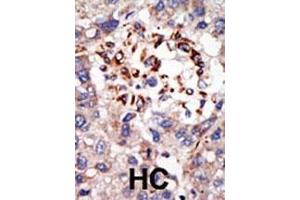 Formalin-fixed and paraffin-embedded human cancer tissue reacted with the primary antibody, which was peroxidase-conjugated to the secondary antibody, followed by DAB staining. (CBX8 抗体  (C-Term))
