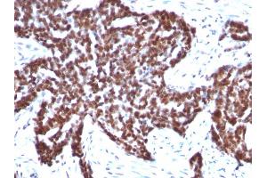 Formalin-fixed, paraffin-embedded human Ovarian Carcinoma stained with Cyclin B1 Mouse Monoclonal Antibody (CCNB1/1098). (Cyclin B1 抗体)