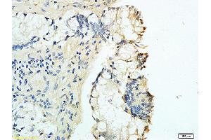 Formalin-fixed and human rectal carcinoma tissue labeled with Anti-B7-H1/PD-L1/CD274 Polyclonal Antibody, Unconjugated (ABIN737706) at 1:200 followed by conjugation to the secondary antibody and DAB staining (PD-L1 抗体  (AA 201-290))