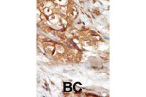 Formalin-fixed and paraffin-embedded human cancer tissue reacted with MAP3K14 polyclonal antibody  , which was peroxidase-conjugated to the secondary antibody, followed by AEC staining. (MAP3K14 抗体  (AA 126-155))