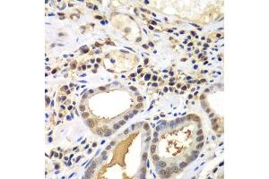 Immunohistochemistry of paraffin-embedded human gastric cancer using PSME2 antibody. (PSME2 抗体  (AA 1-239))