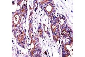 NPM1 antibody immunohistochemistry analysis in formalin fixed and paraffin embedded human colon carcinoma.
